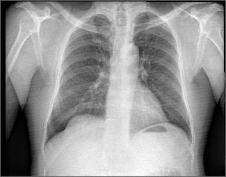 Radiographie numérique thoracique de face