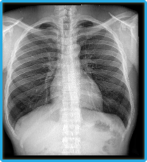 Radiographie numérique throracique de face